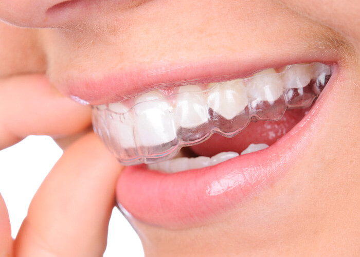 Invisalign Aligner FAQ - Questions and answers about the invisible braces